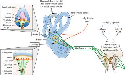 Residual dizziness after BPPV management: exploring pathophysiology and treatment beyond canalith repositioning maneuvers